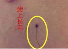 痣上长毛能剪掉吗？专业去痣上长毛方法